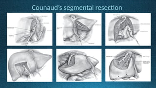 Counaud’s segmental resection
 