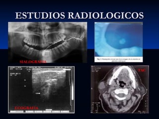 ESTUDIOS RADIOLOGICOS

SIALOGRAFIA
TAC

ECOGRAFIA

 