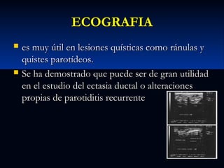 ECOGRAFIA




es muy útil en lesiones quísticas como ránulas y
quistes parotídeos.
Se ha demostrado que puede ser de gran utilidad
en el estudio del ectasia ductal o alteraciones
propias de parotiditis recurrente

 