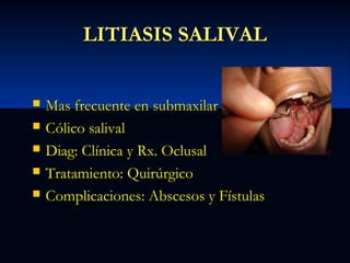 LITIASIS SALIVAL






Mas frecuente en submaxilar
Cólico salival
Diag: Clínica y Rx. Oclusal
Tratamiento: Quirúrgico
Complicaciones: Abscesos y Fístulas

 