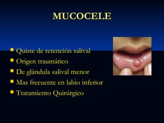 MUCOCELE







Quiste de retención salival
Origen traumático
De glándula salival menor
Mas frecuente en labio inferior
Tratamiento Quirúrgico

 