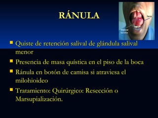 RÁNULA







Quiste de retención salival de glándula salival
menor
Presencia de masa quística en el piso de la boca
Ránula en botón de camisa si atraviesa el
milohioideo
Tratamiento: Quirúrgico: Resección o
Marsupialización.

 