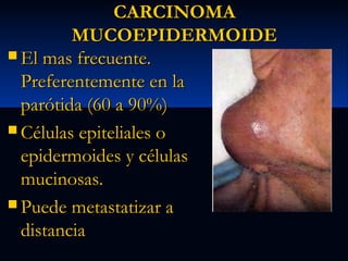 CARCINOMA
MUCOEPIDERMOIDE
 El mas frecuente.
Preferentemente en la
parótida (60 a 90%)
 Células epiteliales o
epidermoides y células
mucinosas.
 Puede metastatizar a
distancia

 