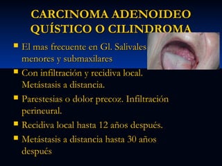 CARCINOMA ADENOIDEO
QUÍSTICO O CILINDROMA









El mas frecuente en Gl. Salivales
menores y submaxilares
Con infiltración y recidiva local.
Metástasis a distancia.
Parestesias o dolor precoz. Infiltración
perineural.
Recidiva local hasta 12 años después.
Metástasis a distancia hasta 30 años
después

 