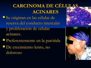 CARCINOMA DE CÉLULAS
ACINARES
Se originan en las células de
reserva del conducto intercalar
y proliferación de células
acinares.
 Preferentemente en la parótida
 De crecimiento lento, no
doloroso


 