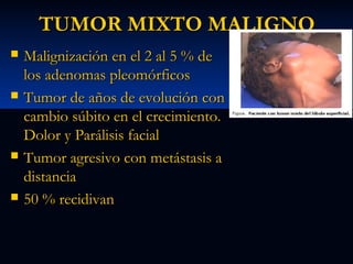 TUMOR MIXTO MALIGNO








Malignización en el 2 al 5 % de
los adenomas pleomórficos
Tumor de años de evolución con
cambio súbito en el crecimiento.
Dolor y Parálisis facial
Tumor agresivo con metástasis a
distancia
50 % recidivan

 
