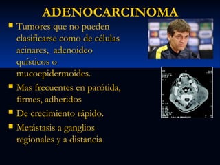 ADENOCARCINOMA







Tumores que no pueden
clasificarse como de células
acinares, adenoideo
quísticos o
mucoepidermoides.
Mas frecuentes en parótida,
firmes, adheridos
De crecimiento rápido.
Metástasis a ganglios
regionales y a distancia

 