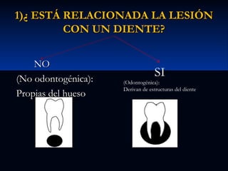 1)¿ ESTÁ RELACIONADA LA LESIÓN
CON UN DIENTE?
NO
(No odontogénica):
Propias del hueso

SI

(Odontogénica):
Derivan de estructuras del diente

 