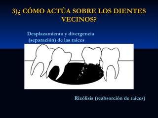 3)¿ CÓMO ACTÚA SOBRE LOS DIENTES
VECINOS?
Desplazamiento y divergencia
(separación) de las raíces

Rizólisis (reabsorción de raíces)

 