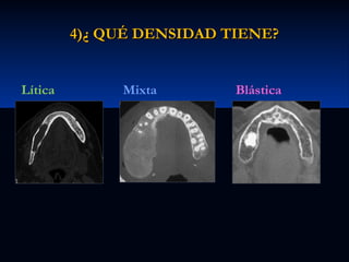 4)¿ QUÉ DENSIDAD TIENE?

Lítica

Mixta

Blástica

 