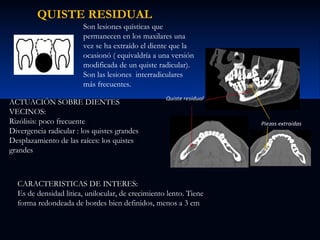 QUISTE RESIDUAL
Son lesiones quísticas que
permanecen en los maxilares una
vez se ha extraído el diente que la
ocasionó ( equivaldría a una versión
modificada de un quiste radicular).
Son las lesiones interradiculares
más frecuentes.
ACTUACIÓN SOBRE DIENTES
VECINOS:
Rizólisis: poco frecuente
Divergencia radicular : los quistes grandes
Desplazamiento de las raíces: los quistes
grandes

CARACTERISTICAS DE INTERES:
Es de densidad litica, unilocular, de crecimiento lento. Tiene
forma redondeada de bordes bien definidos, menos a 3 cm

 