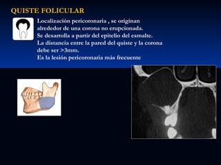 QUISTE FOLICULAR
Localización pericoronaria , se originan
alrededor de una corona no erupcionada.
Se desarrolla a partir del epitelio del esmalte.
La distancia entre la pared del quiste y la corona
debe ser >3mm.
Es la lesión pericoronaria más frecuente

 