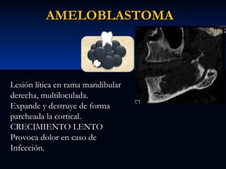 AMELOBLASTOMA

Lesión lítica en rama mandibular
derecha, multiloculada.
Expande y destruye de forma
parcheada la cortical.
CRECIMIENTO LENTO
Provoca dolor en caso de
Infección.

 