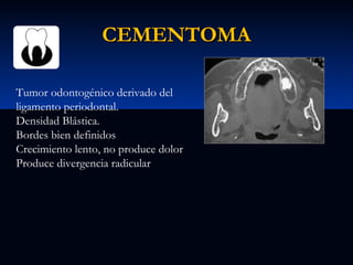 CEMENTOMA
Tumor odontogénico derivado del
ligamento periodontal.
Densidad Blástica.
Bordes bien definidos
Crecimiento lento, no produce dolor
Produce divergencia radicular

 