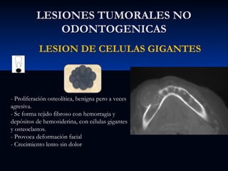 LESIONES TUMORALES NO
ODONTOGENICAS
LESION DE CELULAS GIGANTES

- Proliferación osteolítica, benigna pero a veces
agresiva.
- Se forma tejido fibroso con hemorragia y
depósitos de hemosiderina, con células gigantes
y osteoclastos.
- Provoca deformación facial
- Crecimiento lento sin dolor

 