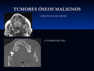 TUMORES ÓSEOS MALIGNOS
CARCINOMA ESCAMOSO

CONDROSARCOMA

 