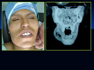 Glándulas salivales