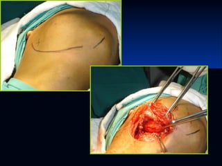 Glándulas salivales