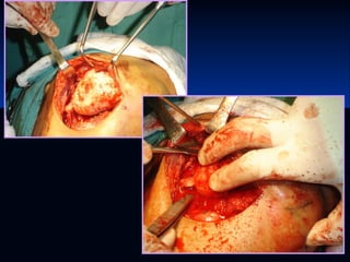 Glándulas salivales