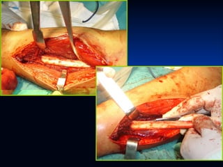 Glándulas salivales