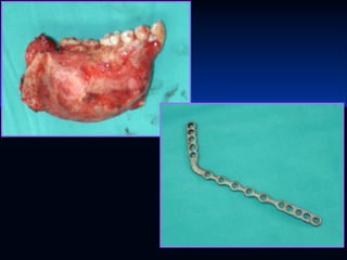 Glándulas salivales