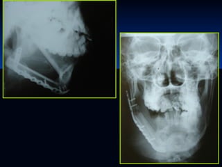 Glándulas salivales