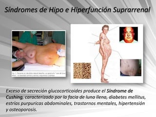 Síndromes de Hipo e Hiperfunción Suprarrenal




Exceso de secreción glucocorticoides produce el Síndrome de
Cushing, caracterizado por la facia de luna llena, diabetes mellitus,
estrías purpuricas abdominales, trastornos mentales, hipertensión
y osteoporosis.
 