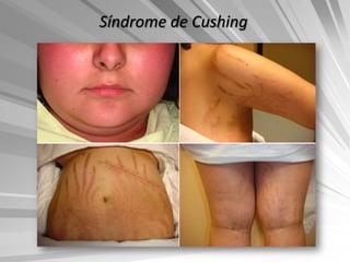 Síndrome de Cushing
 