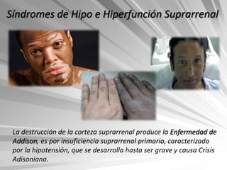 Síndromes de Hipo e Hiperfunción Suprarrenal




 La destrucción de la corteza suprarrenal produce la Enfermedad de
 Addison, es por insuficiencia suprarrenal primaria, caracterizado
 por la hipotensión, que se desarrolla hasta ser grave y causa Crisis
 Adisoniana.
 