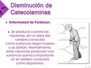 Enfermedad de Parkinson.
Se produce cuando las
neuronas, en un área del
cerebro conocida
como sustancia negra mueren
o se dañan. Normalmente,
estas neuronas producen una
sustancia química importante
en el cerebro conocida
como dopamina.
 