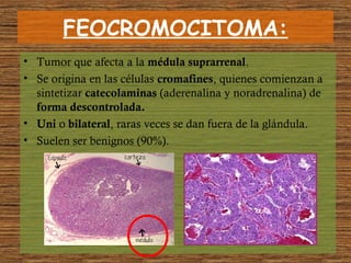 FEOCROMOCITOMA:
• Tumor que afecta a la médula suprarrenal.
• Se origina en las células cromafines, quienes comienzan a
sintetizar catecolaminas (aderenalina y noradrenalina) de
forma descontrolada.
• Uni o bilateral, raras veces se dan fuera de la glándula.
• Suelen ser benignos (90%).
 