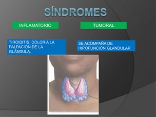 INFLAMATORIO
TIROIDITIS, DOLOR A LA
PALPACIÓN DE LA
GLÁNDULA.
TUMORAL
SE ACOMPAÑA DE
HIPOFUNCIÓN GLANDULAR
 