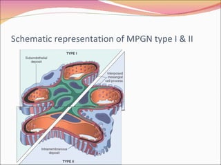 Schematic representation of MPGN type I & II 