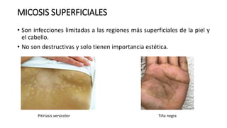 MICOSIS SUPERFICIALES
• Son infecciones limitadas a las regiones más superficiales de la piel y
el cabello.
• No son destructivas y solo tienen importancia estética.
Pitiriasis versicolor Tiña negra
 