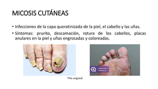 MICOSIS CUTÁNEAS
• Infecciones de la capa queratinizada de la piel, el cabello y las uñas.
• Síntomas: prurito, descamación, rotura de los cabellos, placas
anulares en la piel y uñas engrosadas y coloreadas.
Tiña ungueal
 