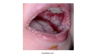 Candidiasis oral
 