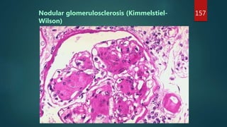 Glomerular disease