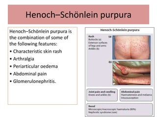 Henoch–Schönlein purpura
Henoch–Schönlein purpura is
the combination of some of
the following features:
• Characteristic skin rash
• Arthralgia
• Periarticular oedema
• Abdominal pain
• Glomerulonephritis.
 