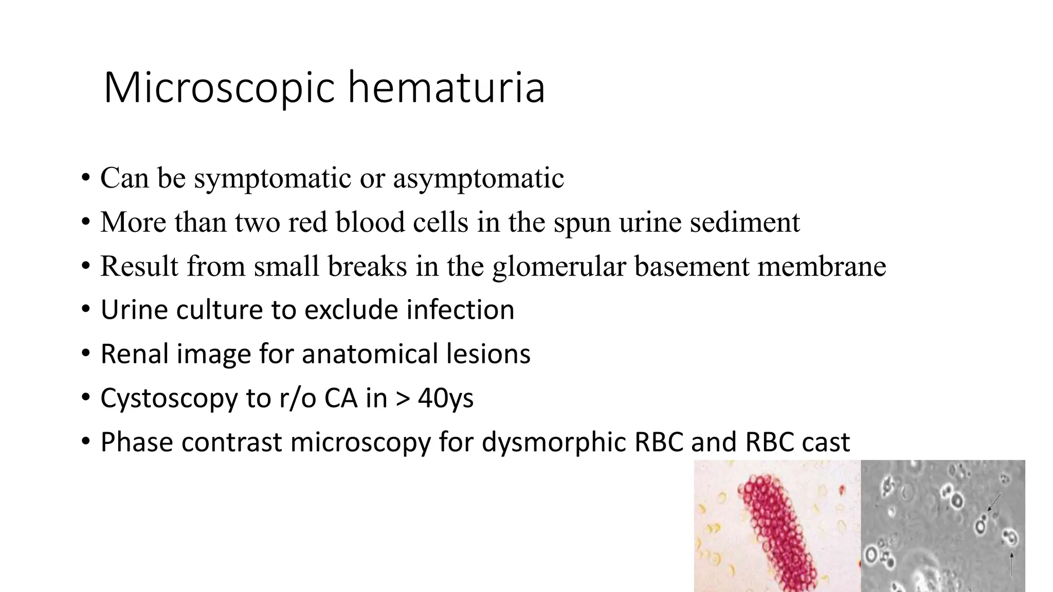 Microscopic hematuria
• Can be symptomatic or asymptomatic
• More than two red blood cells in the spun urine sediment
• Result from small breaks in the glomerular basement membrane
• Urine culture to exclude infection
• Renal image for anatomical lesions
• Cystoscopy to r/o CA in > 40ys
• Phase contrast microscopy for dysmorphic RBC and RBC cast
 