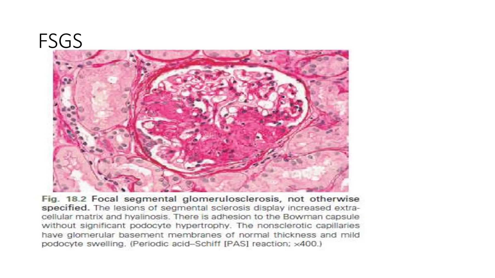 FSGS
 