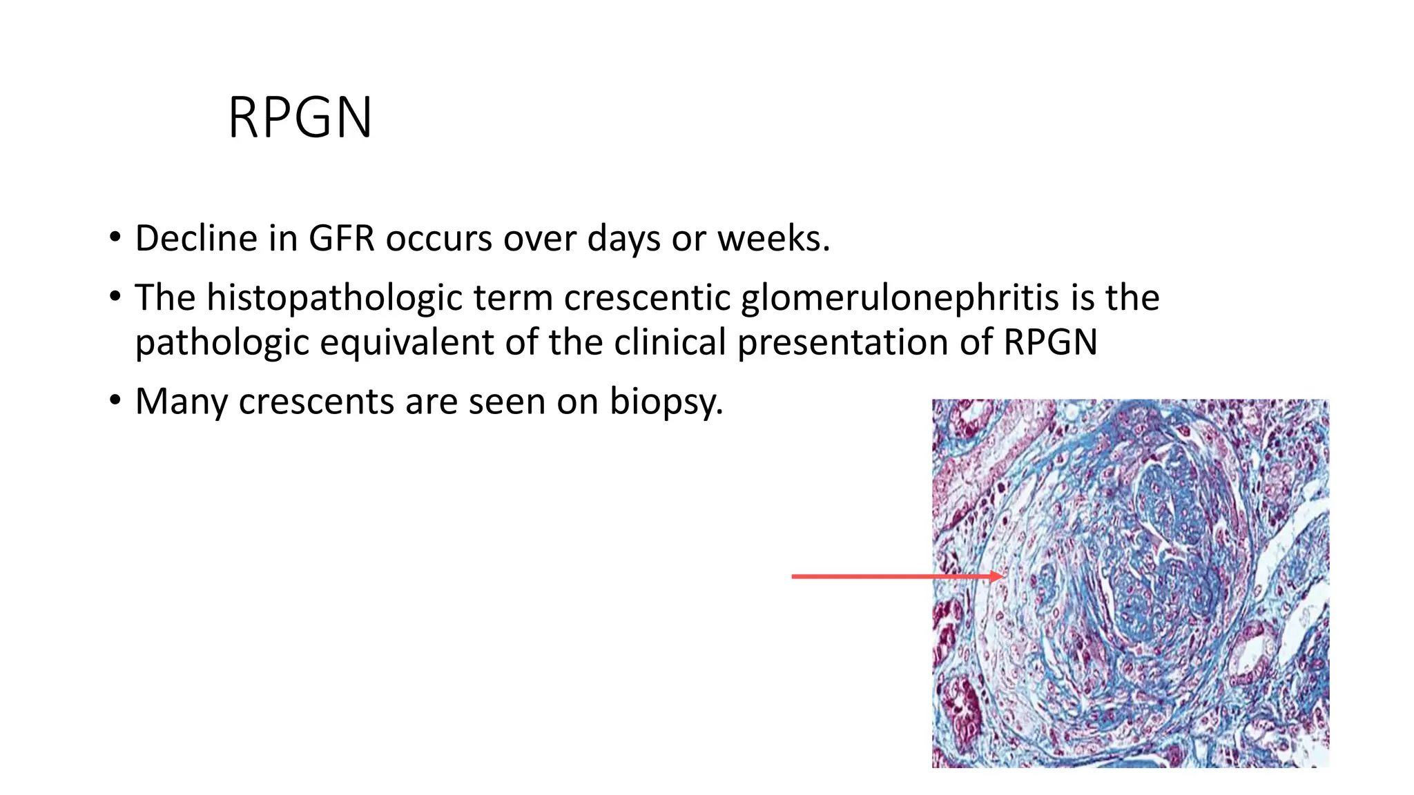 RPGN
• Decline in GFR occurs over days or weeks.
• The histopathologic term crescentic glomerulonephritis is the
pathologic equivalent of the clinical presentation of RPGN
• Many crescents are seen on biopsy.
 