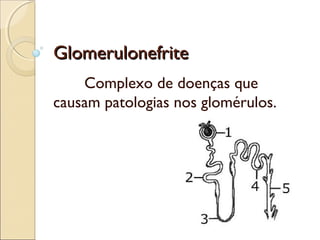 GGlloommeerruulloonneeffrriittee 
Complexo de doenças que 
causam patologias nos glomérulos. 
 