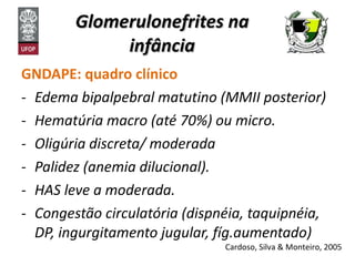 Glomerulonefrites na infância GNDAPE: quadro clínico Edema bipalpebral matutino (MMII posterior) Hematúria macro (até 70%) ou micro. Oligúria discreta/ moderada Palidez (anemia dilucional). HAS leve a moderada. Congestão circulatória (dispnéia, taquipnéia, DP, ingurgitamento jugular, fíg.aumentado) Cardoso, Silva & Monteiro, 2005 
