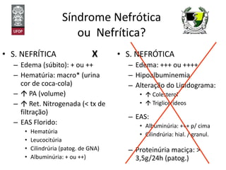 Síndrome Nefrótica  ou  Nefrítica?  S. NEFRÍTICA Edema (súbito): + ou ++ Hematúria: macro* (urina cor de coca-cola)    PA (volume)    Ret. Nitrogenada (< tx de filtração) EAS Florido: Hematúria Leucocitúria Cilindrúria (patog. de GNA) Albuminúria: + ou ++) S. NEFRÓTICA Edema: +++ ou ++++ Hipoalbuminemia Alteração do Lipidograma:    Colesterol    Triglicerídeos EAS: Albuminúria: +++ p/ cima Cilindrúria: hial. / granul. Proteinúria maciça: > 3,5g/24h (patog.) X 