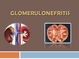GLOMERULONEFRITISGLOMERULONEFRITIS
 