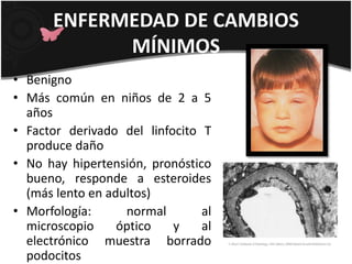 ENFERMEDAD DE CAMBIOS
MÍNIMOS
• Benigno
• Más común en niños de 2 a 5
años
• Factor derivado del linfocito T
produce daño
• No hay hipertensión, pronóstico
bueno, responde a esteroides
(más lento en adultos)
• Morfología: normal al
microscopio óptico y al
electrónico muestra borrado
podocitos
 