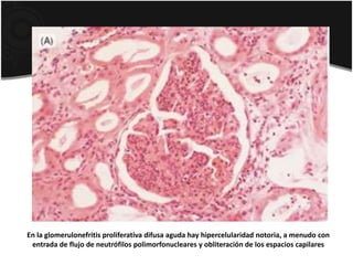 En la glomerulonefritis proliferativa difusa aguda hay hipercelularidad notoria, a menudo con
entrada de flujo de neutrófilos polimorfonucleares y obliteración de los espacios capilares
 