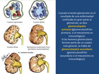 Cuando la lesión glomerular es el
 resultado de una enfermedad
    confinada en gran parte al
        glomérulo, se dice
          glomerulopatía
  primaria (glomerulonefritis
  primaria, si el mecanismo es
          inmunológico).
  Si las lesiones glomerulares
   forman parte de un cuadro
     más general, se habla de
  glomerulopatía secundaria
        (glomerulonefritis
 secundaria si el mecanismo es
          inmunológico).
 