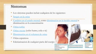 Síntomas
• Los síntomas pueden incluir cualquiera de los siguientes:
• Sangre en la orina
• Cambios en el estado mental, como disminución en la lucidez mental o
disminución en la concentración
• Orina turbia
• Orina oscura (color humo, cola o té)
• Disminución en el volumen de orina
• Orina espumosa
• Edematizacion de cualquier parte del cuerpo
 