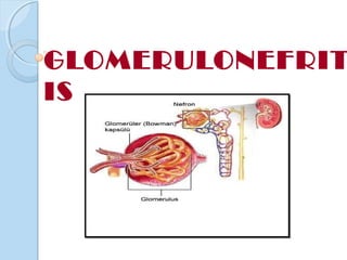 GLOMERULONEFRIT
IS
 